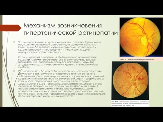 Механизм возникновения гипертонической ретинопатии Чаще повреждаются сосуды хориоидеи, сетчатки. Происходит нарушение сосудистой