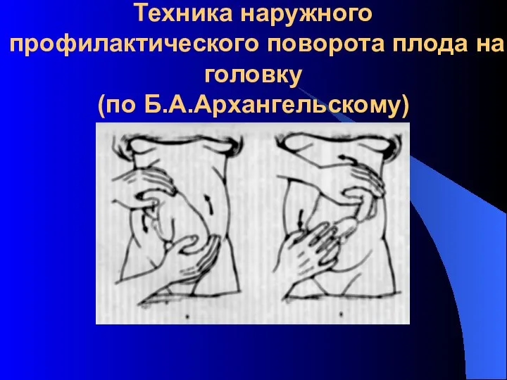 Техника наружного профилактического поворота плода на головку (по Б.А.Архангельскому)