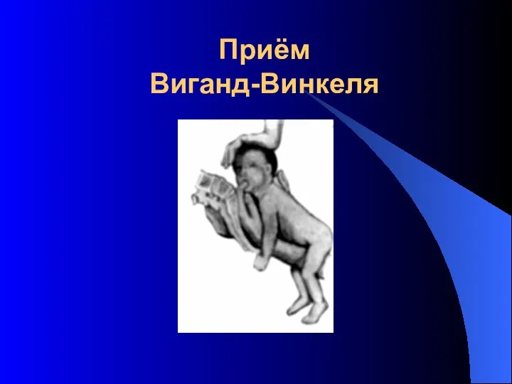 Приём Виганд-Винкеля