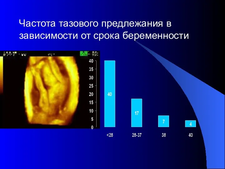 Частота тазового предлежания в зависимости от срока беременности