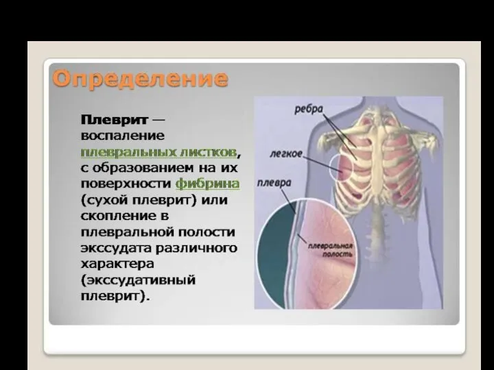 ПЛЕВРИТЫ