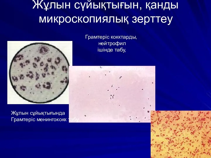 Жұлын сүйықтығын, қанды микроскопиялық зерттеу Жұлын сұйықтығында Грамтеріс менингококк табу Грамтеріс кокктарды,