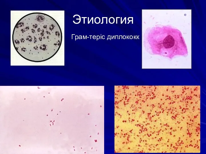 Этиология Грам-теріс диплококк