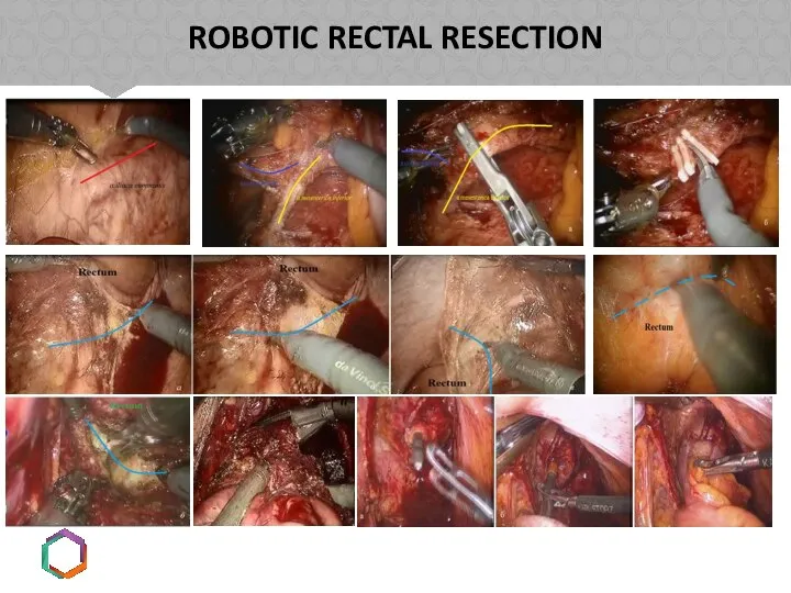 ROBOTIC RECTAL RESECTION