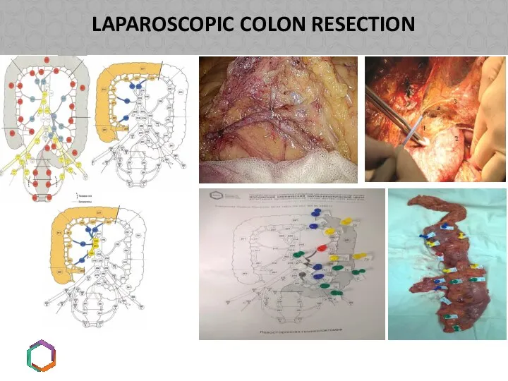 LAPAROSCOPIC COLON RESECTION