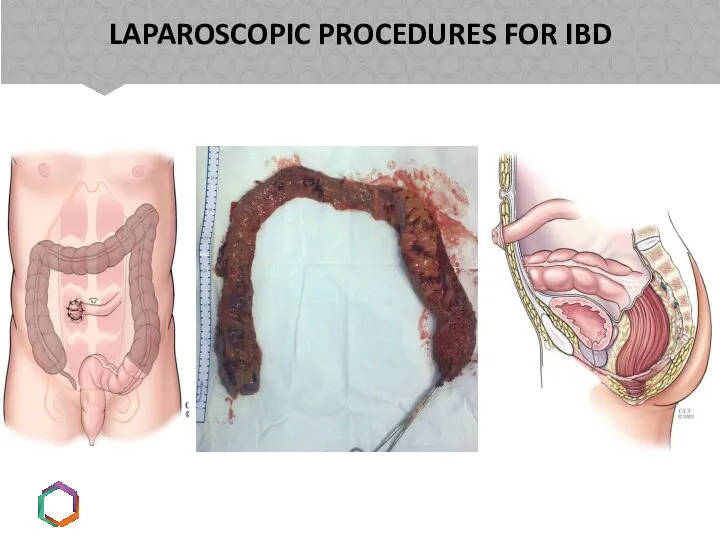 LAPAROSCOPIC PROCEDURES FOR IBD