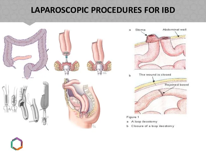 LAPAROSCOPIC PROCEDURES FOR IBD