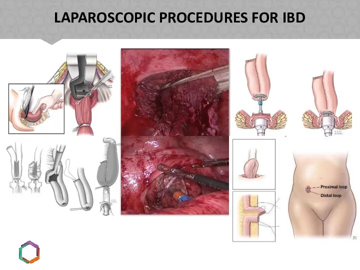 LAPAROSCOPIC PROCEDURES FOR IBD