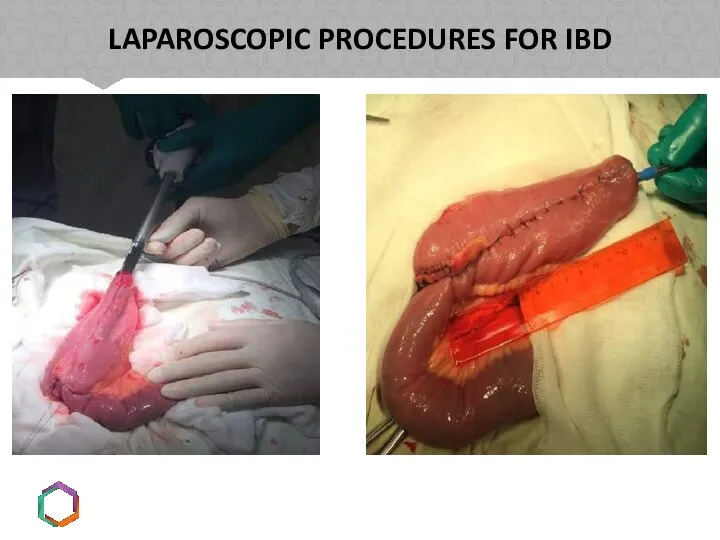 LAPAROSCOPIC PROCEDURES FOR IBD