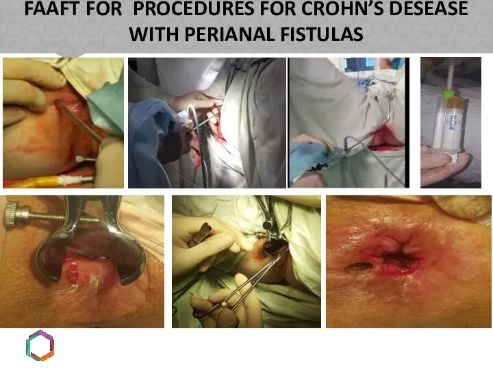 FAAFT FOR PROCEDURES FOR CROHN’S DESEASE WITH PERIANAL FISTULAS