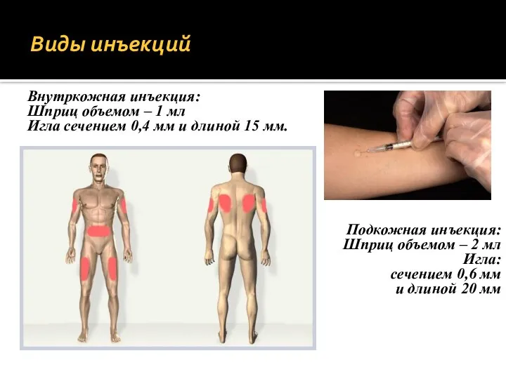 Виды инъекций Внутркожная инъекция: Шприц объемом – 1 мл Игла сечением 0,4