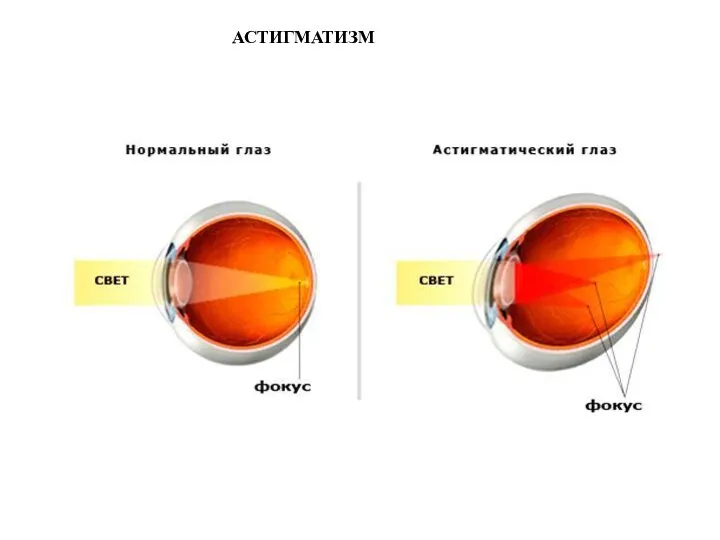 АСТИГМАТИЗМ