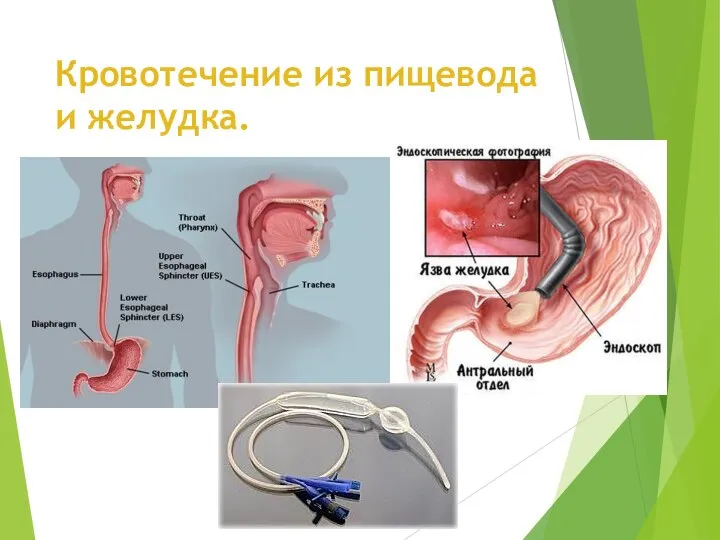 Кровотечение из пищевода и желудка.