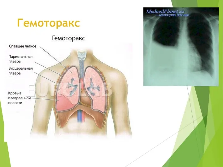 Гемоторакс