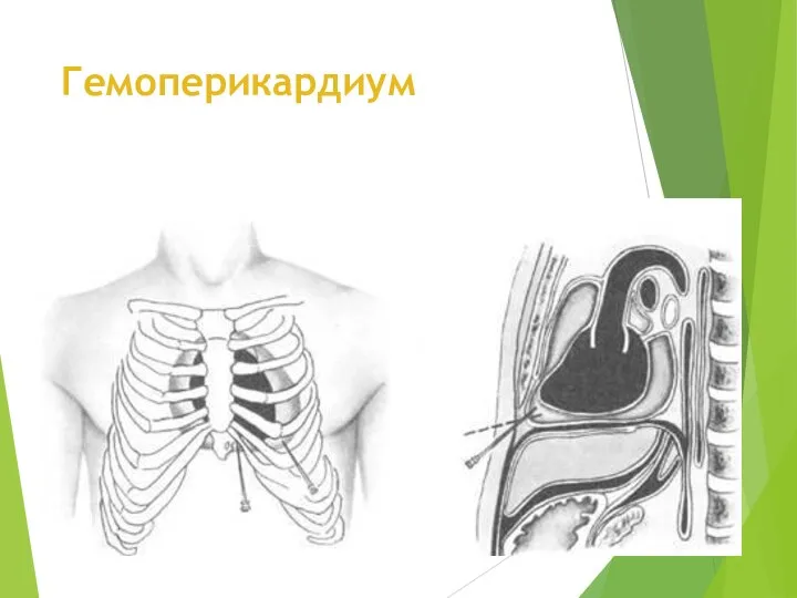 Гемоперикардиум