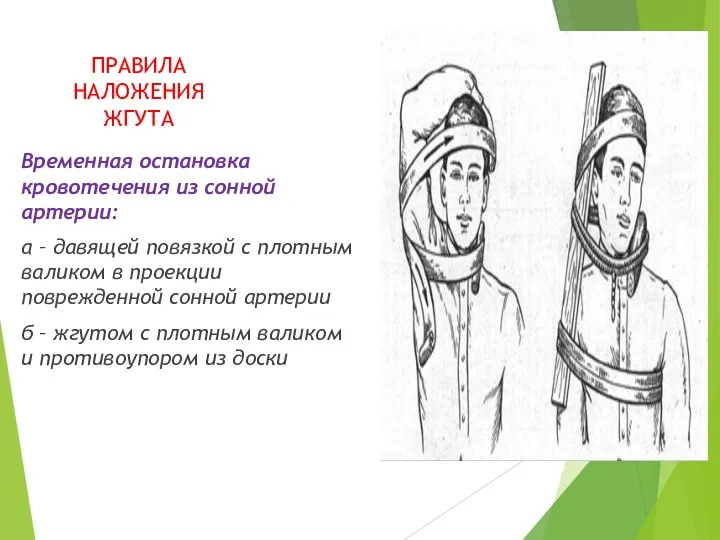 ПРАВИЛА НАЛОЖЕНИЯ ЖГУТА Временная остановка кровотечения из сонной артерии: а – давящей