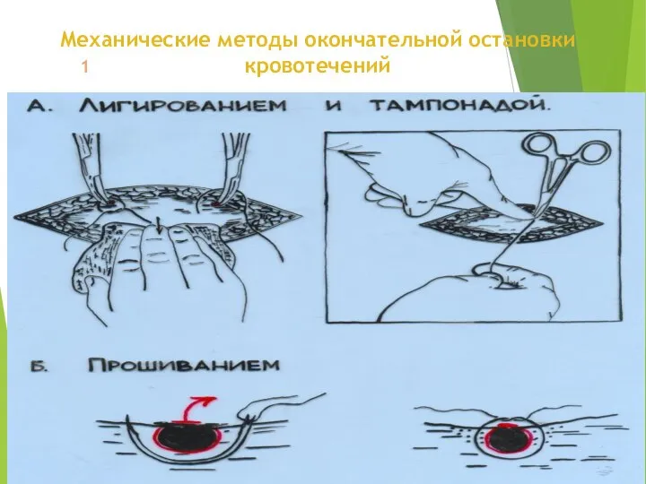 1 Механические методы окончательной остановки кровотечений