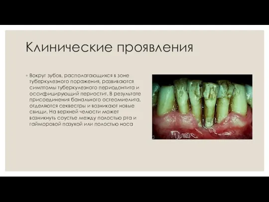 Клинические проявления Вокруг зубов, располагающихся в зоне туберкулезного поражения, развиваются симптомы туберкулезного