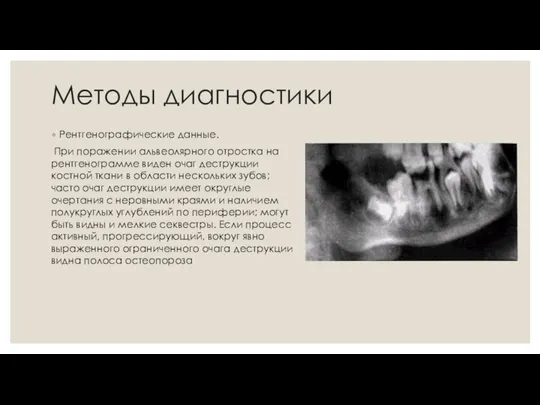 Методы диагностики Рентгенографические данные. При поражении альвеолярного отростка на рентгенограмме виден очаг