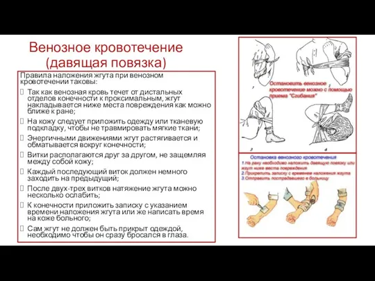 Венозное кровотечение (давящая повязка) Правила наложения жгута при венозном кровотечении таковы: Так