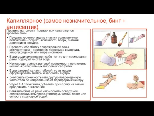 Капиллярное (самое незначительное, бинт + антисептик) Правила наложения повязки при капиллярном кровотечении: