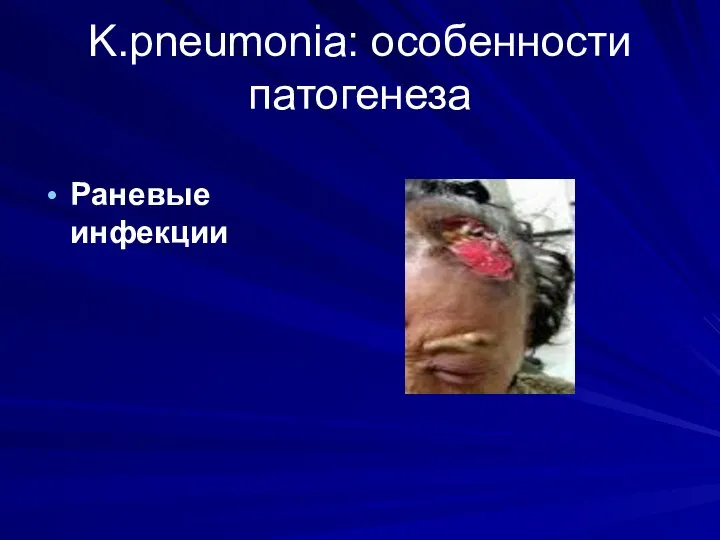 K.pneumonia: особенности патогенеза Раневые инфекции