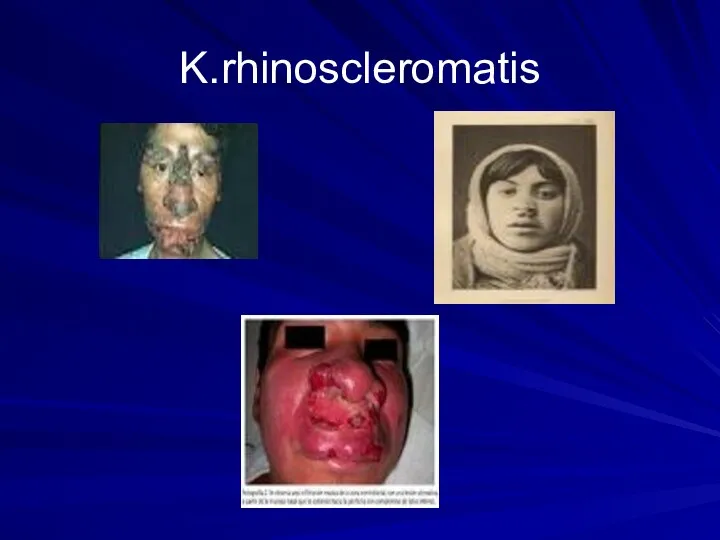 K.rhinoscleromatis