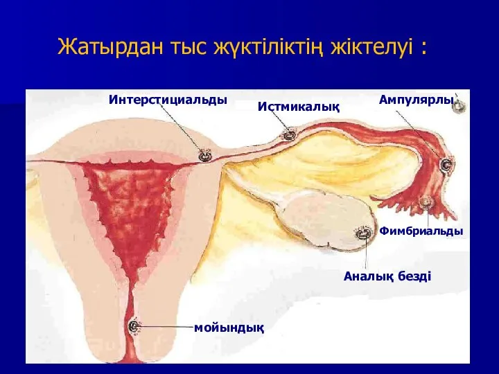 Жатырдан тыс жүктіліктің жіктелуі : Интерстициальды Истмикалық Ампулярлы Фимбриальды Аналық безді мойындық