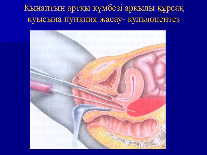 Қынаптың артқы күмбезі арқылы құрсақ қуысына пункция жасау- кульдоцентез