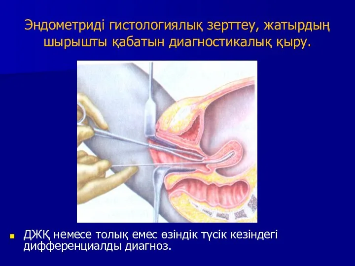 Эндометриді гистологиялық зерттеу, жатырдың шырышты қабатын диагностикалық қыру. ДЖҚ немесе толық емес