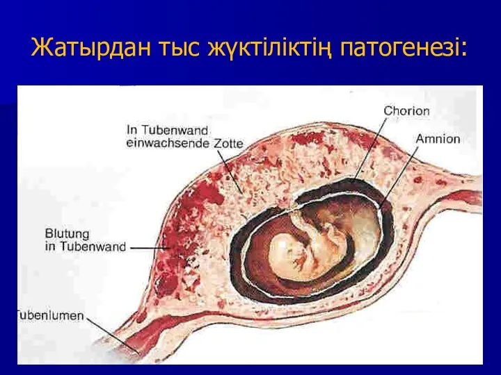 Жатырдан тыс жүктіліктің патогенезі: