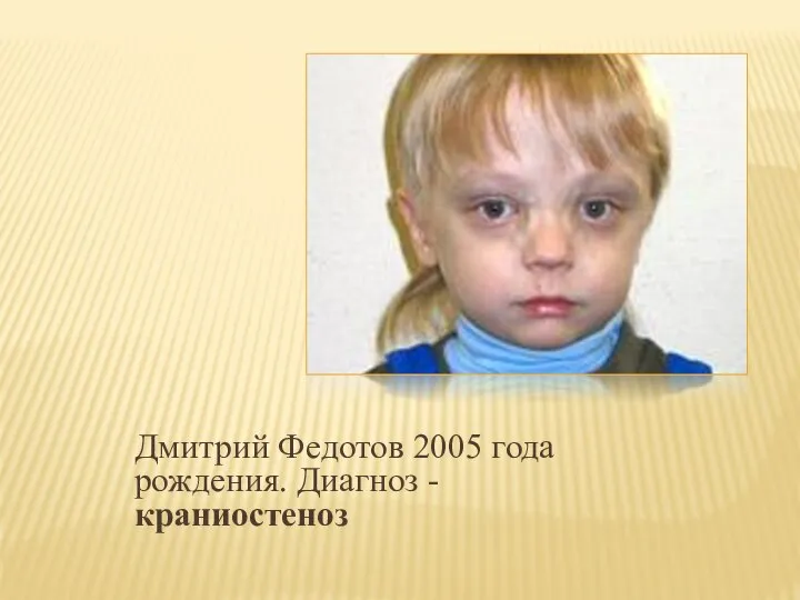 Дмитрий Федотов 2005 года рождения. Диагноз -краниостеноз