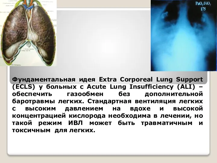Фундаментальная идея Extra Corporeal Lung Support (ECLS) у больных c Acute Lung