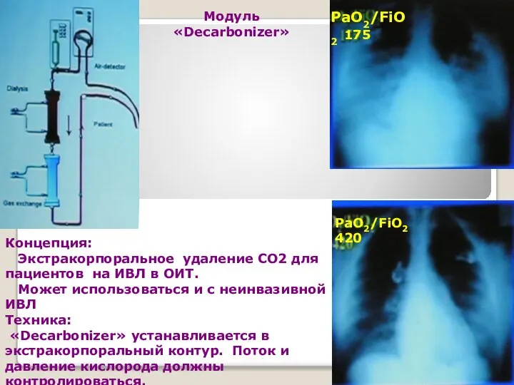 PaO2/FiO2 175 PaO2/FiO2 420 Концепция: Экстракорпоральное удаление СО2 для пациентов на ИВЛ