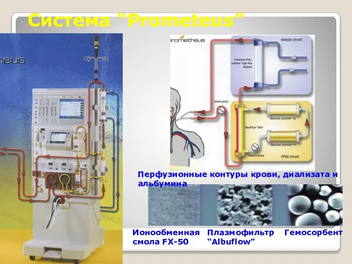 Система “Prometeus” Ионообменная смола FX-50 Плазмофильтр “Albuflow” Гемосорбент Перфузионные контуры крови, диализата и альбумина
