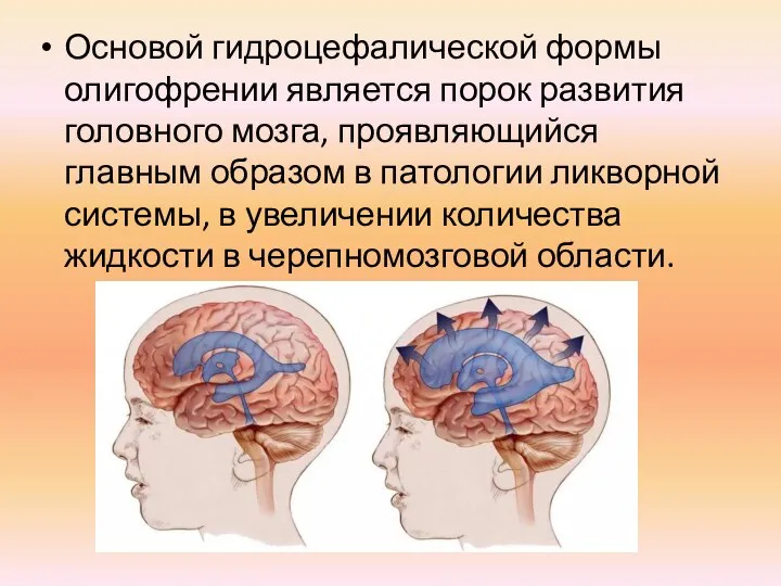 Основой гидроцефалической формы олигофрении является порок развития головного мозга, проявляющийся главным образом
