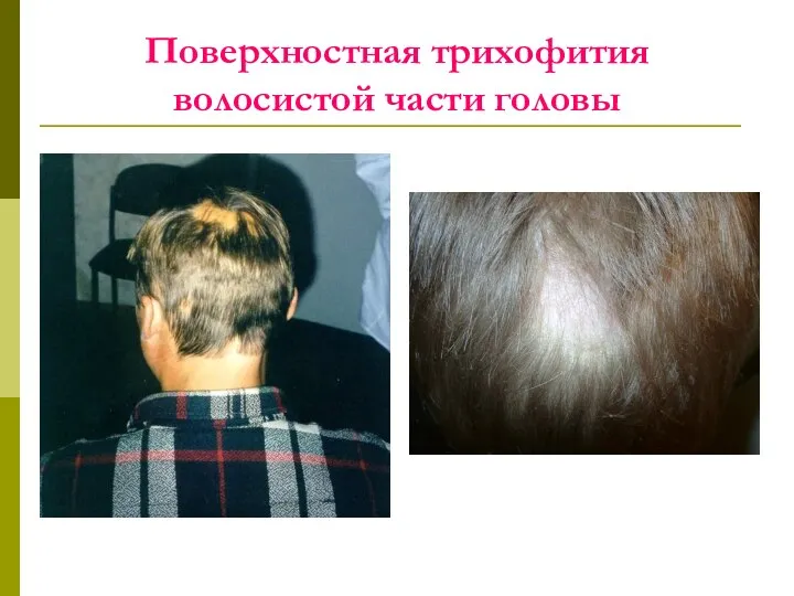 Поверхностная трихофития волосистой части головы