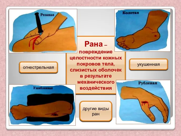 Рана – повреждение целостности кожных покровов тела, слизистых оболочек в результате механического