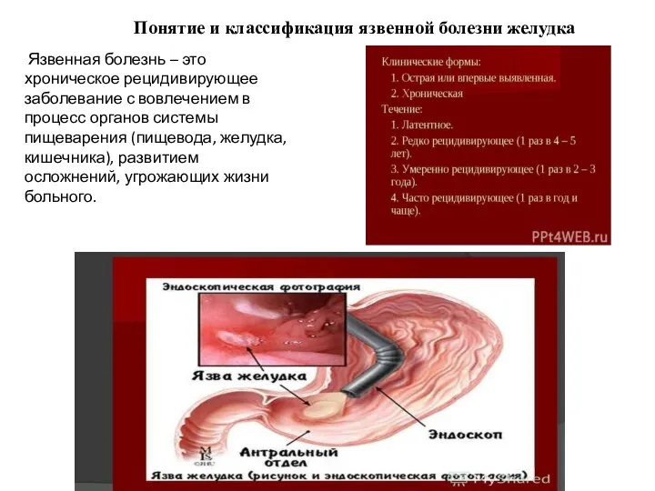 Понятие и классификация язвенной болезни желудка Язвенная болезнь – это хроническое рецидивирующее