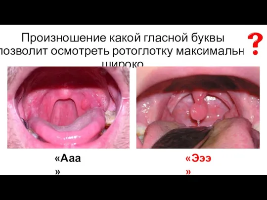 Произношение какой гласной буквы позволит осмотреть ротоглотку максимально широко «Эээ» «Ааа»