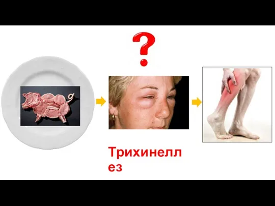 Трихинеллез