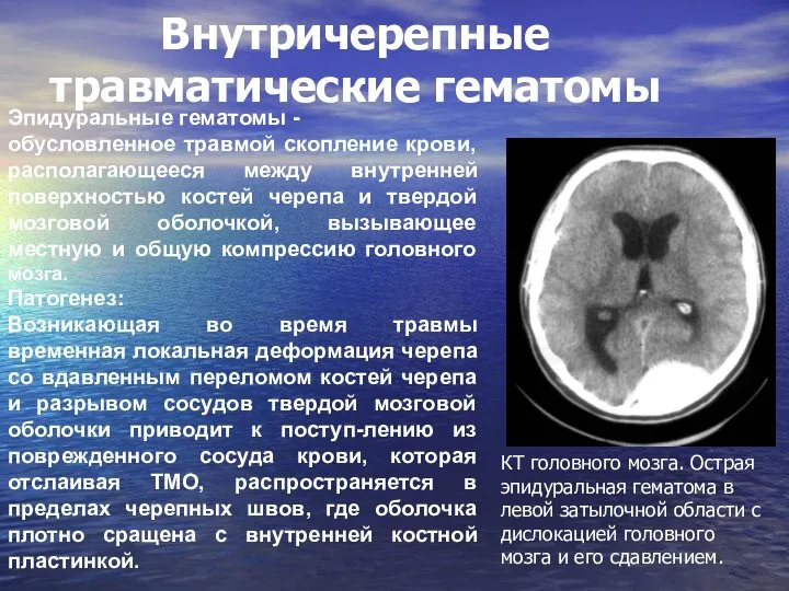 Эпидуральные гематомы - обусловленное травмой скопление крови, располагающееся между внутренней поверхностью костей