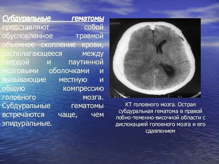 Субдуральные гематомы представляют собой обусловленное травмой объемное скопление крови, располагающееся между твердой