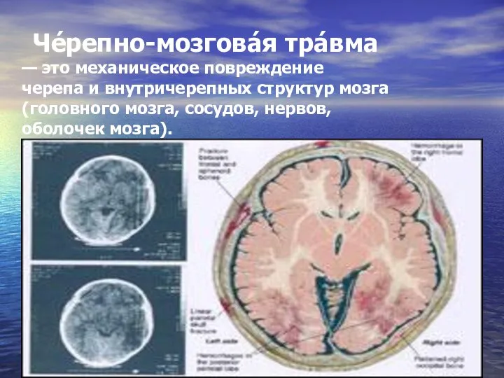 Че́репно-мозгова́я тра́вма — это механическое повреждение черепа и внутричерепных структур мозга(головного мозга, сосудов, нервов, оболочек мозга).