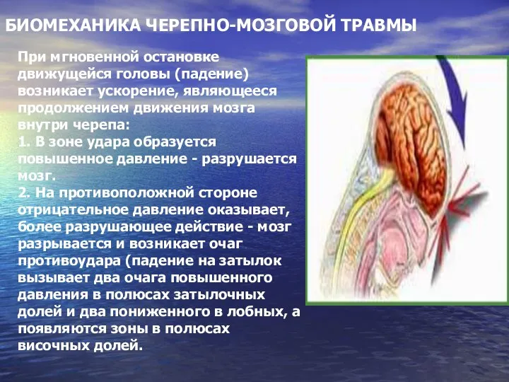 При мгновенной остановке движущейся головы (падение) возникает ускорение, являющееся продолжением движения мозга