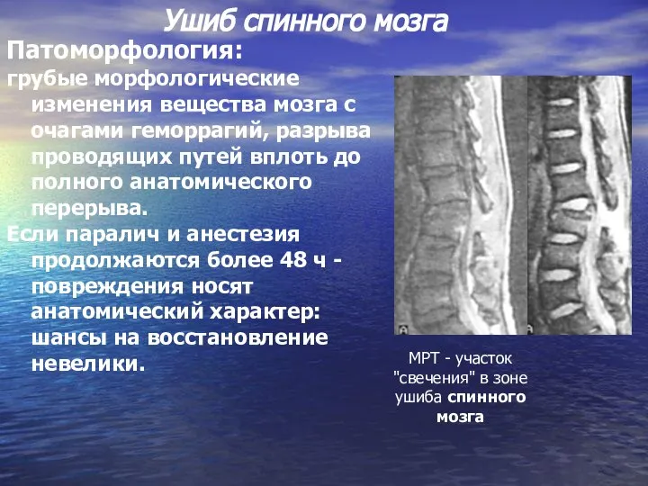 Патоморфология: грубые морфологические изменения вещества мозга с очагами геморрагий, разрыва проводящих путей