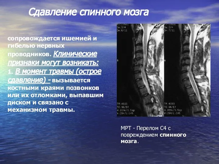 сопровождается ишемией и гибелью нервных проводников. Клинические признаки могут возникать: 1. В