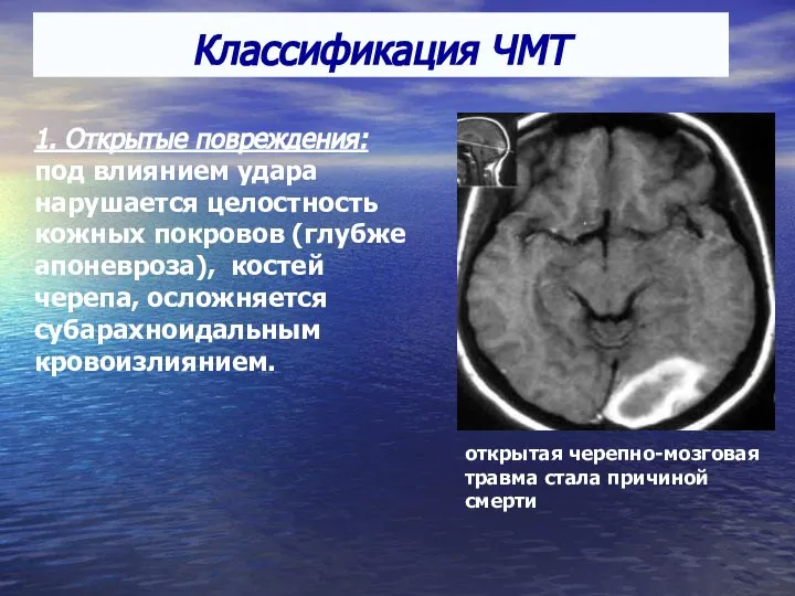 Классификация ЧМТ 1. Открытые повреждения: под влиянием удара нарушается целостность кожных покровов