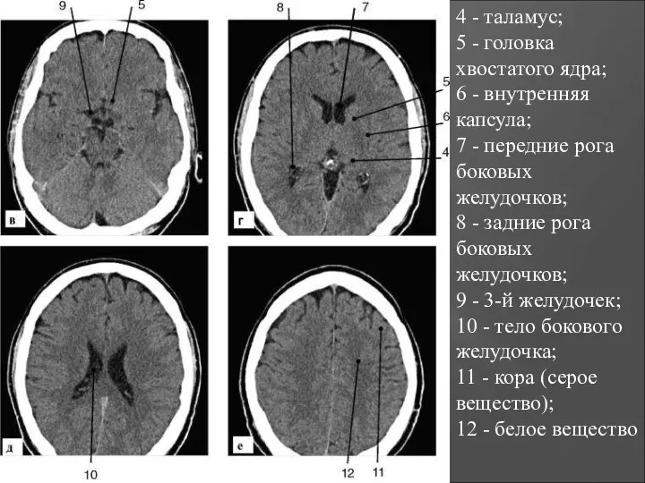 4 - таламус; 5 - головка хвостатого ядра; 6 - внутренняя капсула;