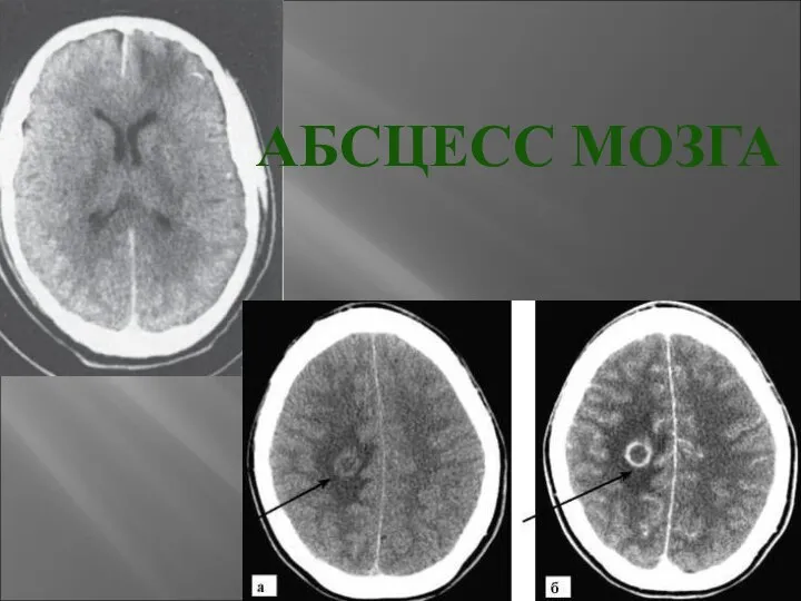 АБСЦЕСС МОЗГА